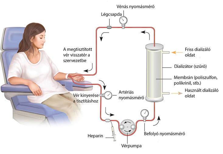 hemodialízis és magas vérnyomás
